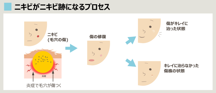 ニキビ痕が残る理由