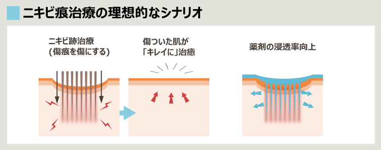 ポテンザでのニキビ痕治療、ニキビ痕治癒のプロセス