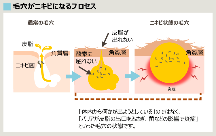 ニキビ形成の過程