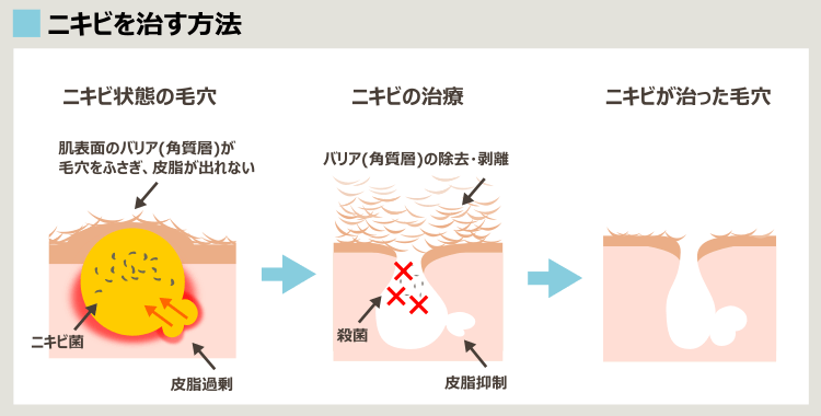 ニキビ治療の基本