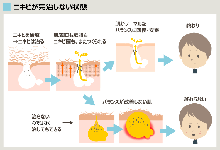 ニキビが根本的に治らない理由