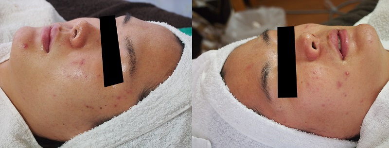 recovery-of-skin-barrier-function-after-chemical-peeling-1