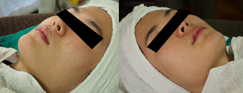 recovery-of-skin-barrier-function-after-chemical-peeling-2