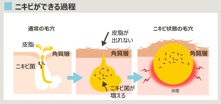 ニキビができるプロセス