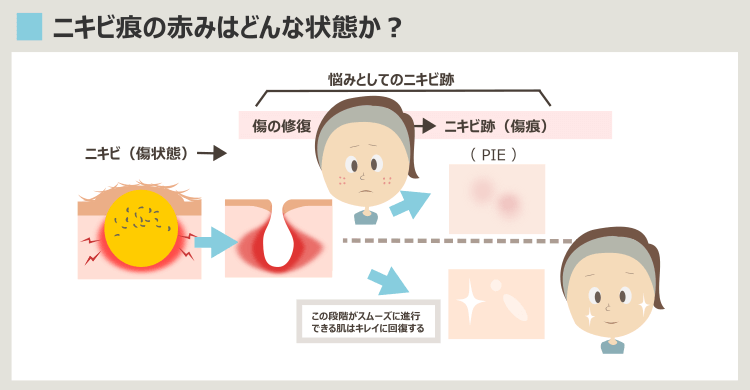 ニキビ跡が治る過程と、赤みが残る原因