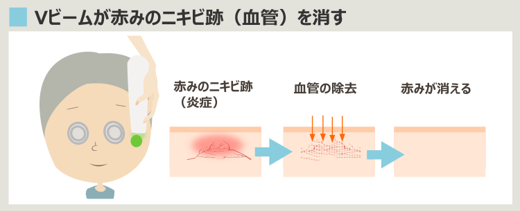 Vビームが血管を破壊して赤みのニキビ痕を消すプロセス