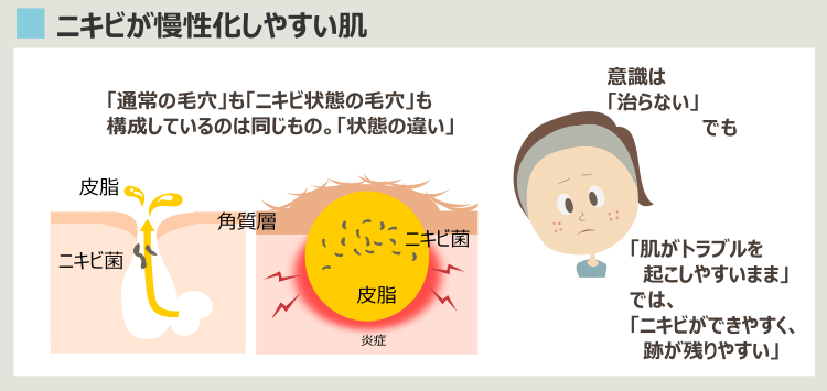 ニキビ痕が残りやすく、ニキビが慢性化しやすい肌の特徴