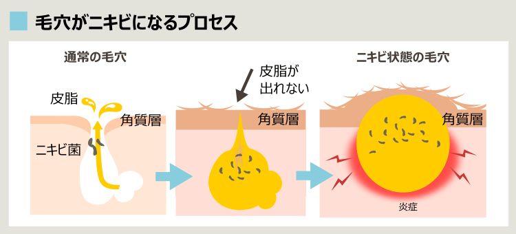 ニキビができるプロセス