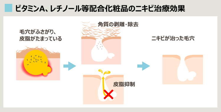 レチノール、ビタミンAのニキビ治療効果