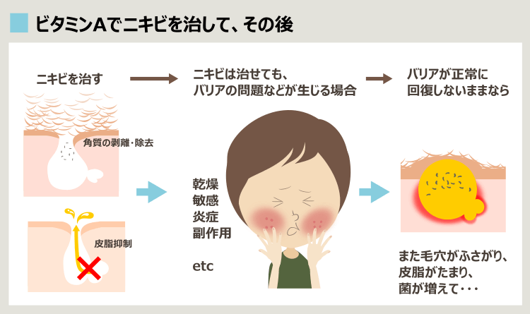 レチノール、ビタミンAでニキビが根本解決しない理由