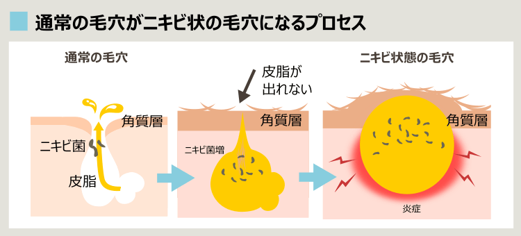 毛穴がニキビになるプロセス