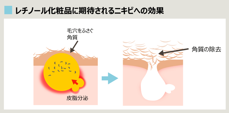 レチノール化粧品がニキビに効く理由