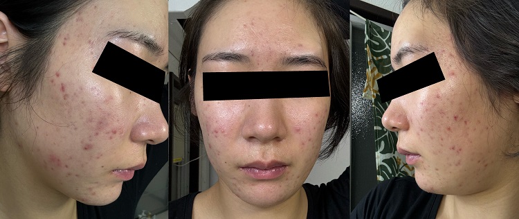 エピュデオでも再発、レーザーやピーリングでも改善しないニキビ