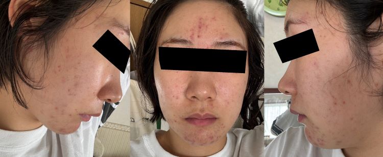 ケア開始後、リバウンドで増えるニキビ