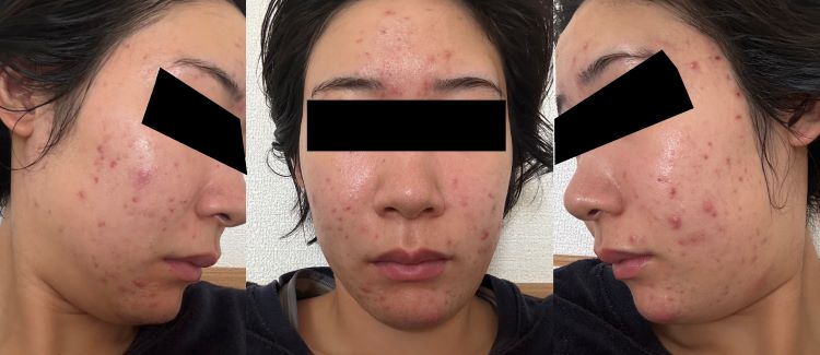 ピーリングによるニキビ悪化