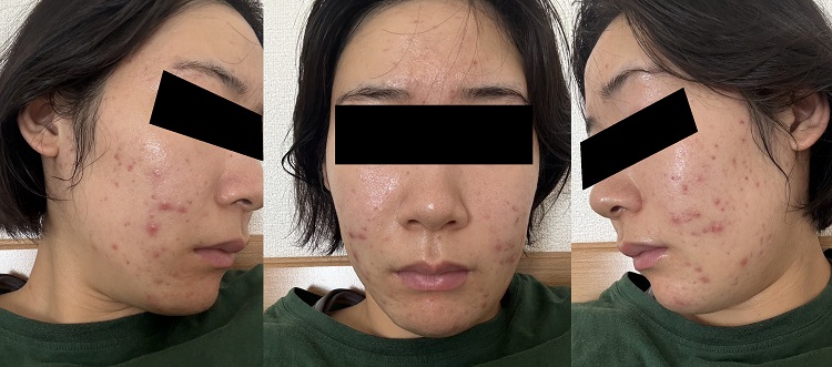 ピーリングで悪化ピーク