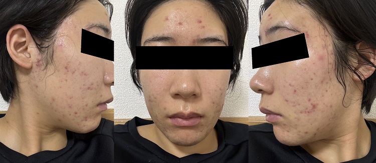 落ち着いてきたニキビ