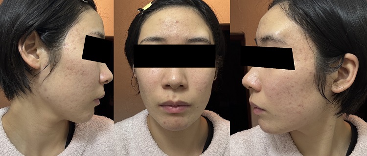 ニキビのピークが過ぎた頃