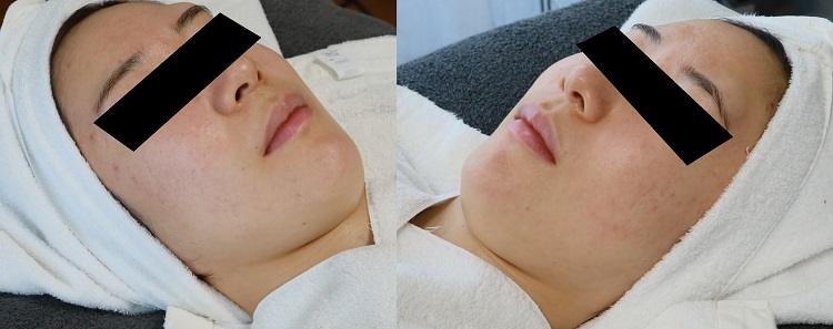 最近の落ち着いた肌状態