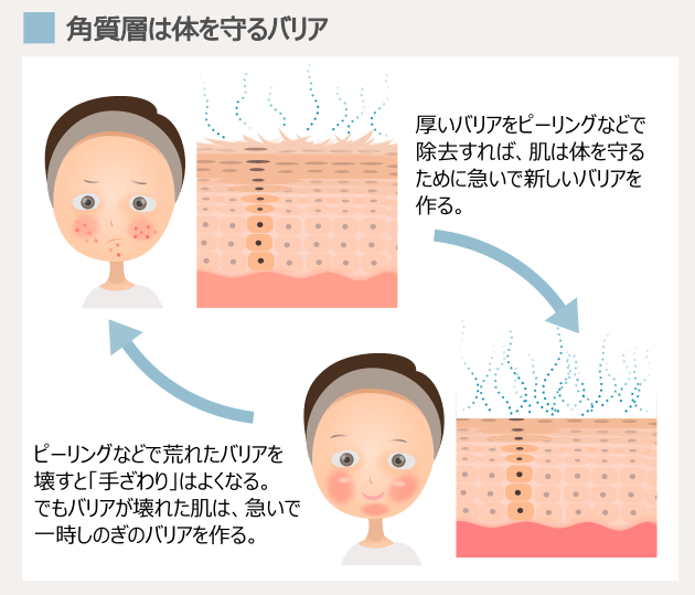 ピーリングでターンオーバーを促してもニキビをくり返す