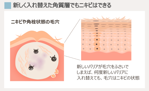 ニキビの時の角質層とターンオーバーの状態