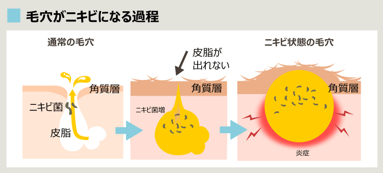 ニキビができる過程