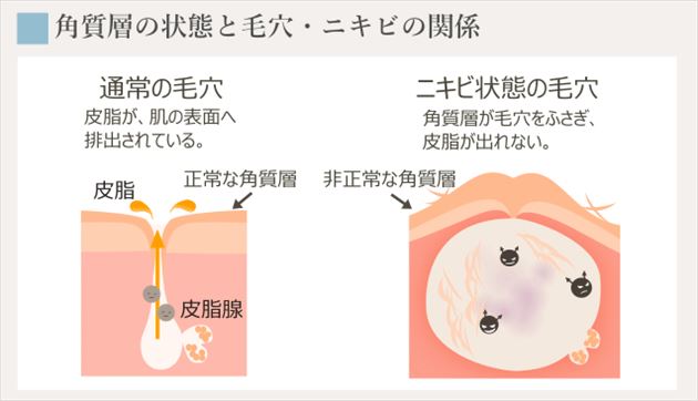 ニキビと角質層の変化