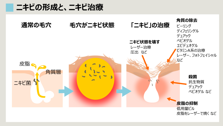 ニキビの原因と、ニキビ治療のバリエーション