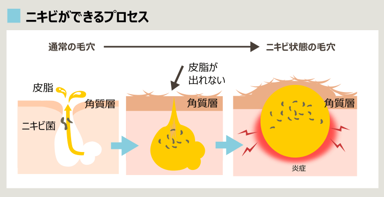 ニキビができるプロセス