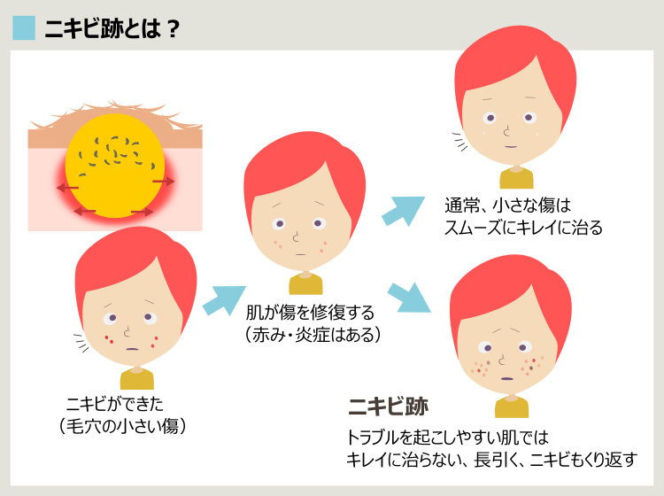 ニキビ跡は、ニキビがキレイに治らなかった状態