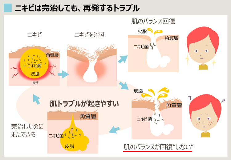 ニキビ跡が残りやすい肌で起きている問題