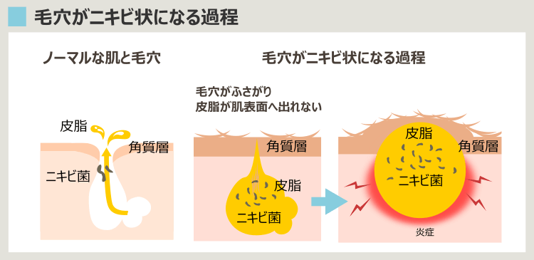 毛穴のニキビ化プロセス