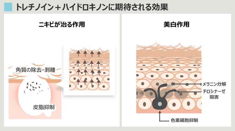 トレチノインのニキビ治療効果とハイドロキノンの美白効果