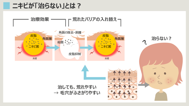 治してもでき続けるニキビ