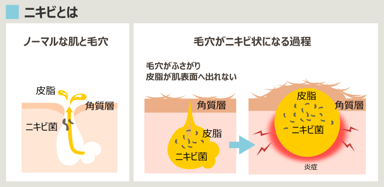 毛穴がニキビになる過程