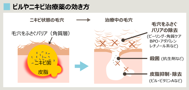 ピルやニキビ治療薬の効果
