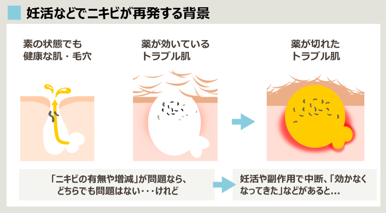 妊活で薬を止めるとニキビが再発する理由