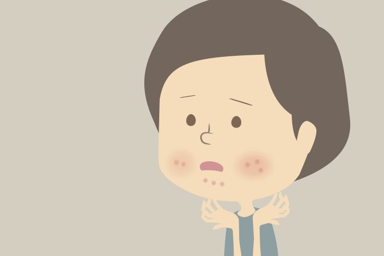 妊活でニキビ復活。どうすれば?