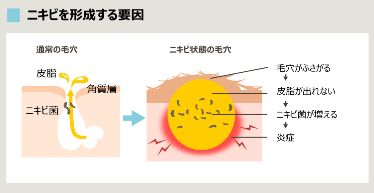 ニキビの形成要因