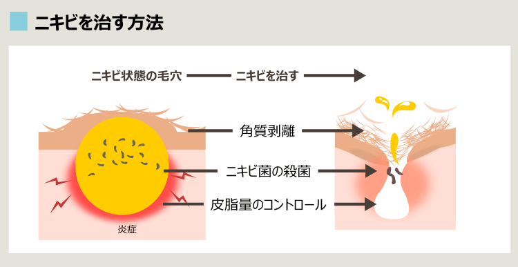 ニキビ治療の概要