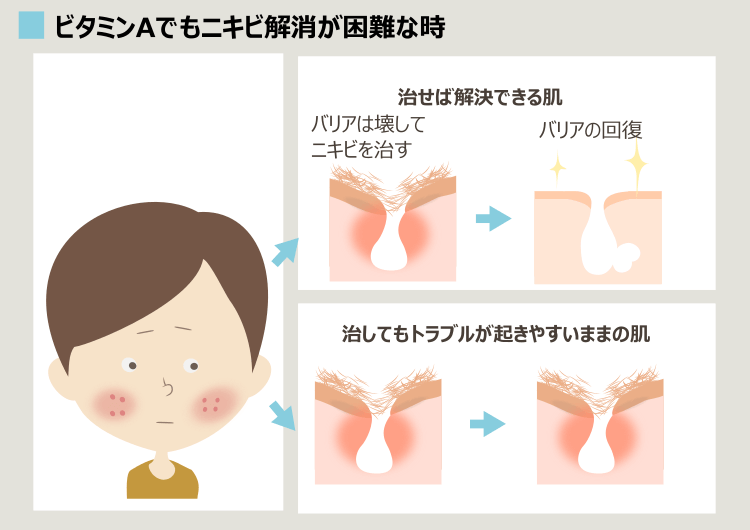 ビタミンA導入でもニキビをくり返す理由