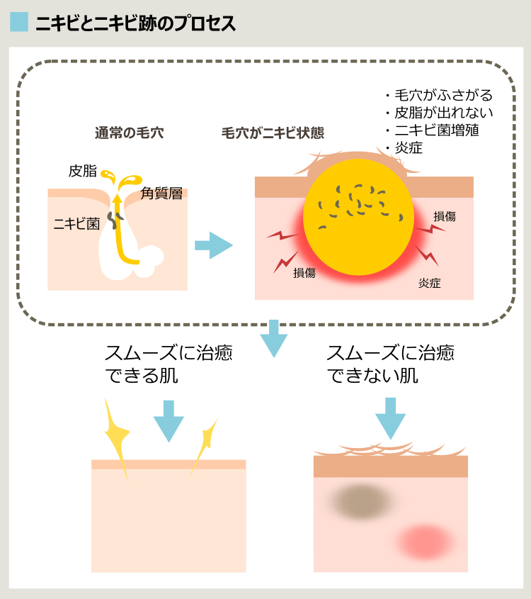 ニキビ痕が残るプロセス