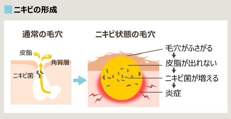 ニキビの原因