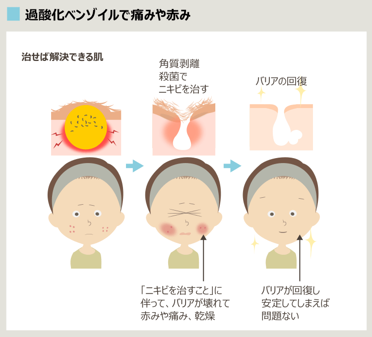 過酸化ベンゾイルのメリット