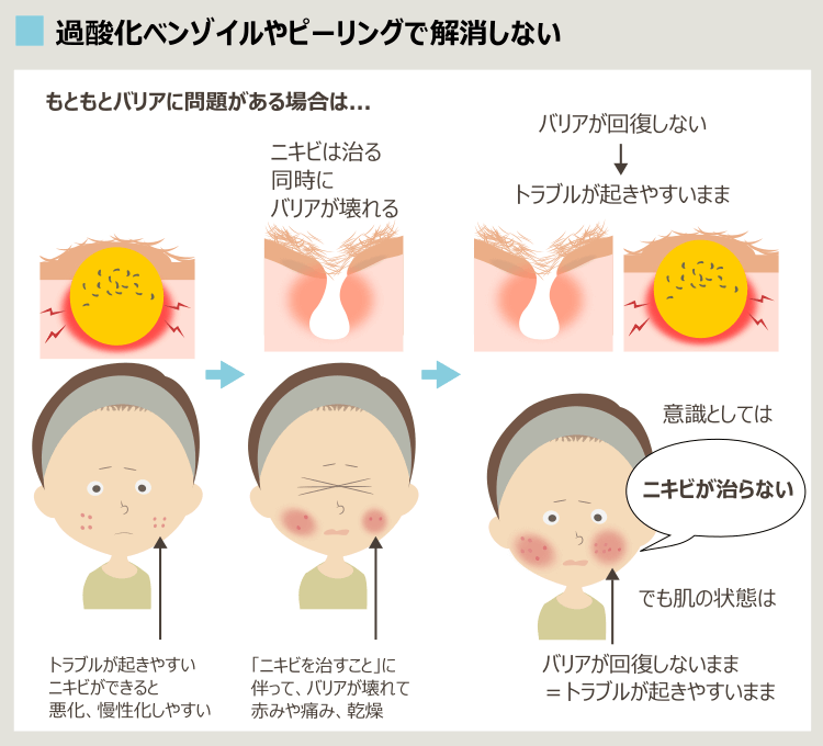 過酸化ベンゾイルのデメリット