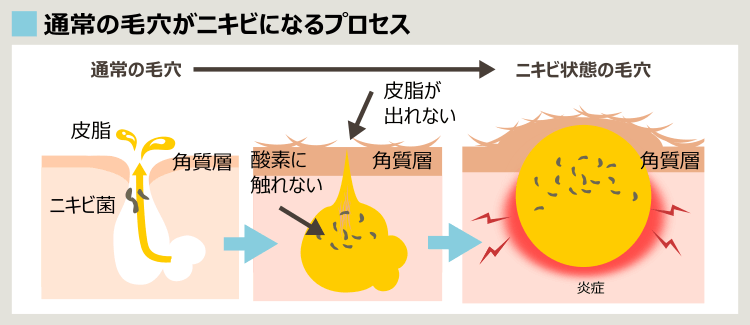 ニキビができるプロセス