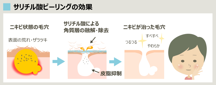 サリチル酸でニキビが治る理由