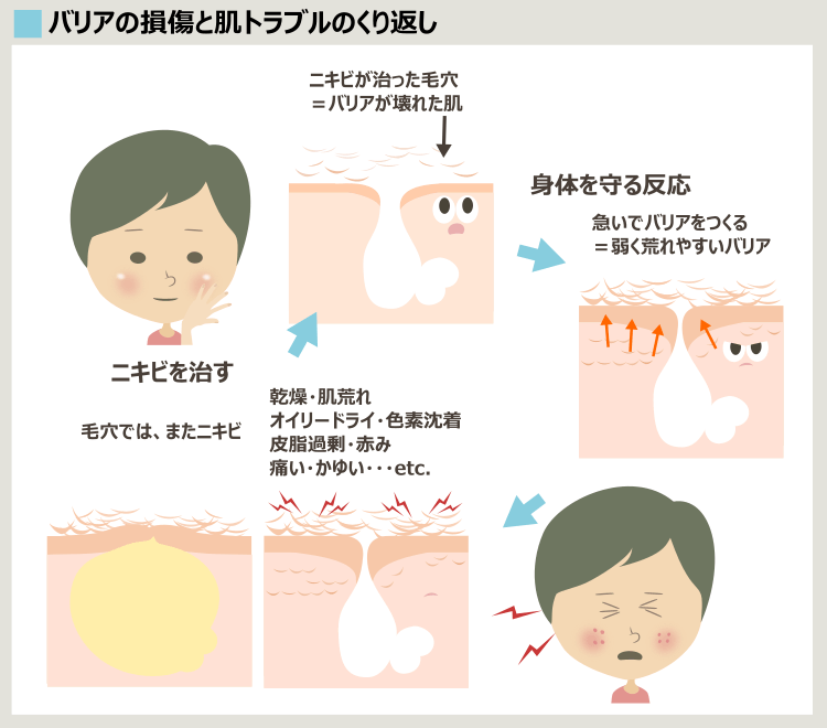 サリチル酸ピーリングでも治らないニキビ