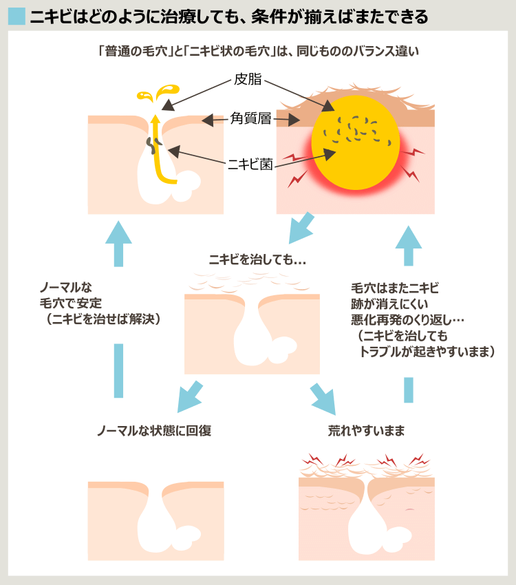 治してもくり返すニキビ