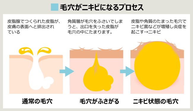 ニキビができるプロセス